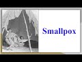 Impact of Smallpox on Native Americans