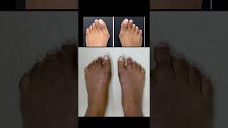 MINIMALLY INVASIVE BUNION SURGERY WITH NO PINS OR SCREWS😎#bunionsurgery #bunioncorrector #juanetes