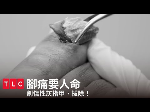 創傷性灰指甲😱頑強抵抗不想給醫生拔！｜腳痛要人命｜TLC 旅遊生活頻道