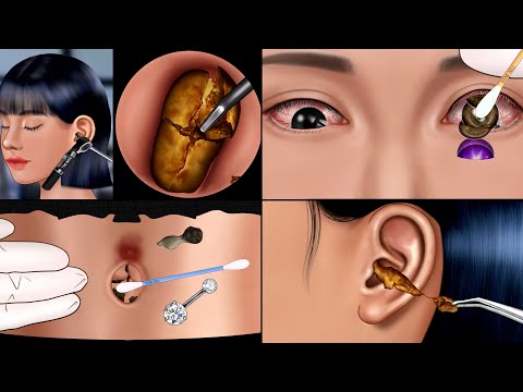 ASMR Satisfying Care Animation‼️ Ear Cleaning, Navel stone & Big Snot Removal, Piercing, Make up