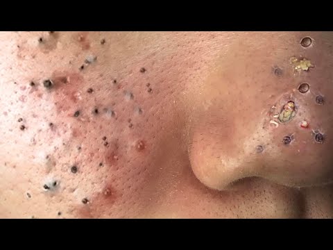 Blackhead Removal With Sac Dep Spa @100074210