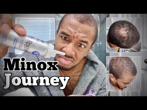 Wait… My Hair is Actually Growing Back?! 🤯🔥 - Week 5 Minoxidil Update