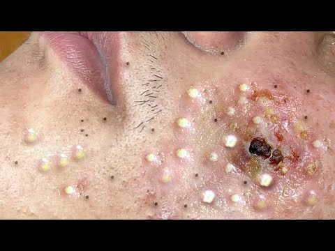 Big Cystic Acne Blackheads Extraction Blackheads & Milia, Whiteheads Removal Pimple Popping # 46743