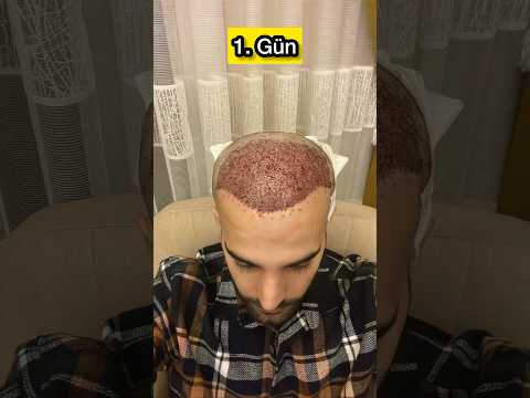 8 aylık Saç ekim sürecim 😂