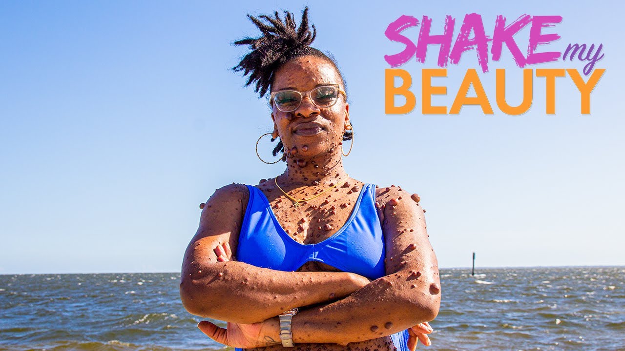 I'm finally revealing my tumours in public - shake my beauty