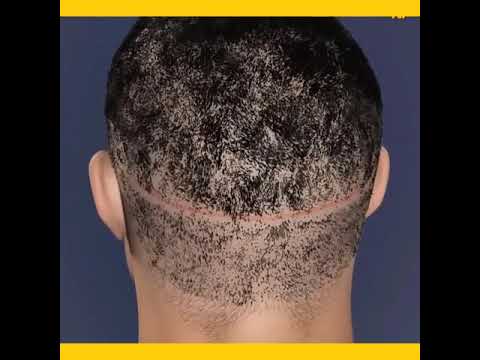 দেখুন টাক মাথায় কিভাবে চুল গজানো হয় । Hair transplant কিভাবে করা হয় #ytshorts