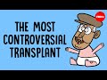 Ethical Implications of Body Transplants
