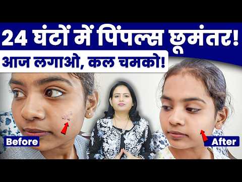 वन-डे पिंपल ट्रीटमेंट – शादी में चमकता चेहरा!
