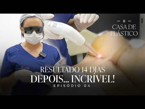Casa de Plástico: Pós‑Operatório Avançado e Laser na Cicatriz | EPISÓDIO 04 | Dr. Ícaro Samuel