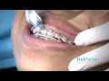 Braces Care and Maintenance