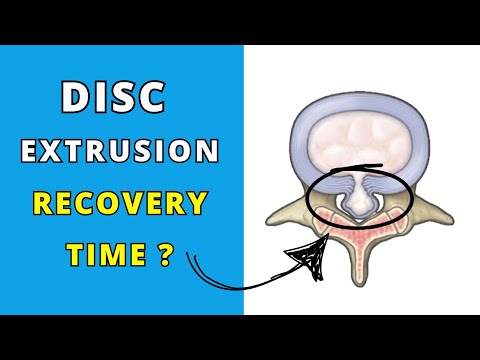 How long does it take for a lumbar disc extrusion to heal? (online client testimonial) #uk