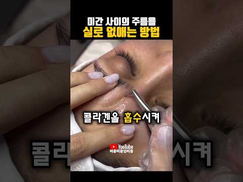 미간 사이의 주름을 실로 없애는 방법