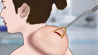 ASMR Remove Huge rear neck Cyst from homeless girl animation