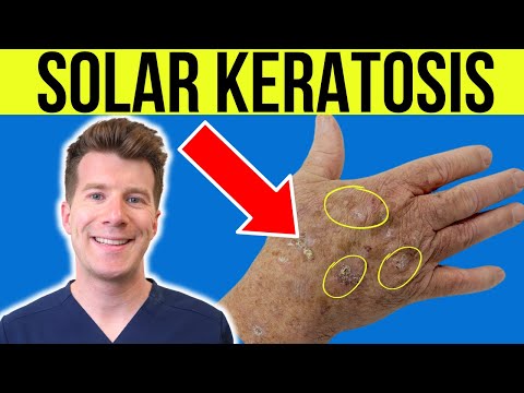 Doctor explains Actinic Solar Keratosis | Sun damaged skin - causes, symptoms and treatment
