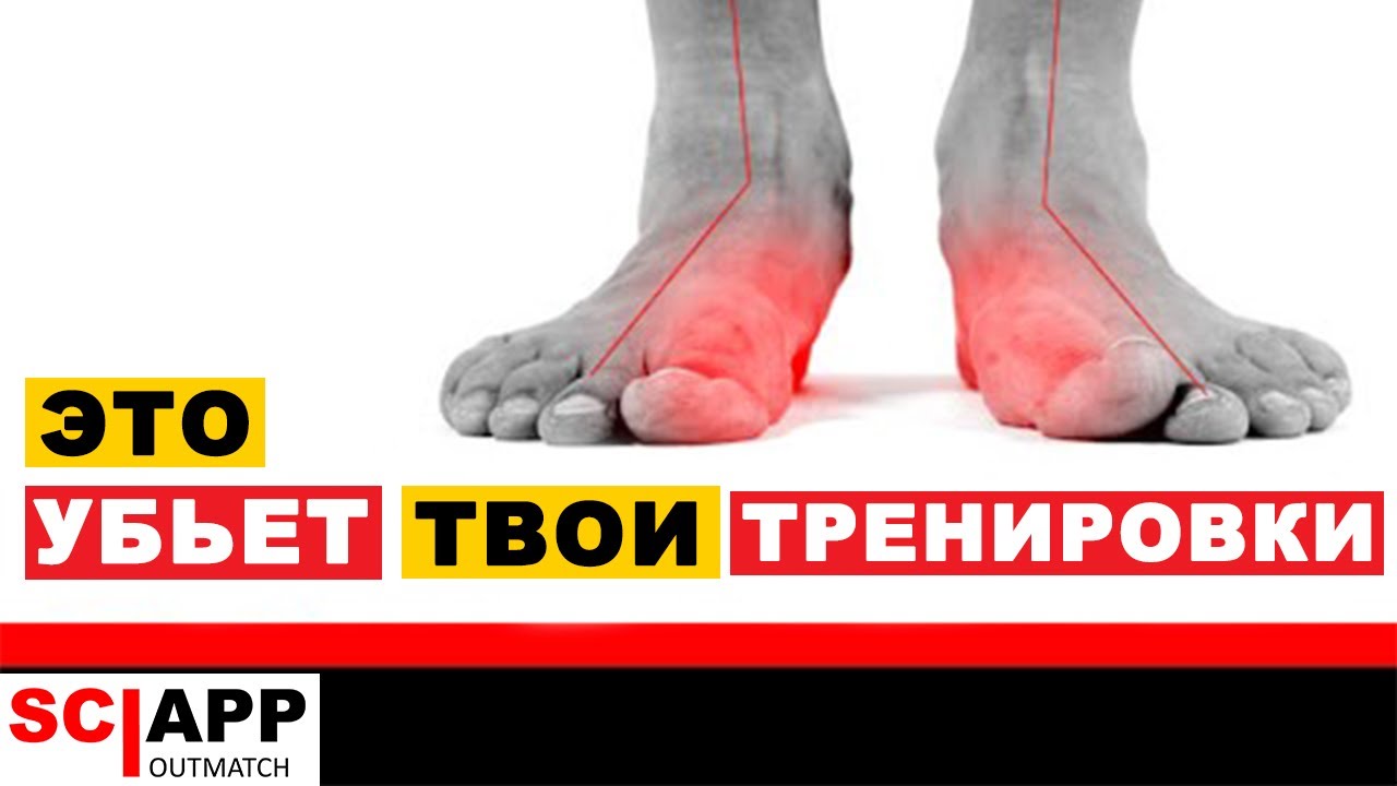 5 Способов Как Плоскостопие Убивает Твои Тренировки, Колени, Бедра и Поясницу