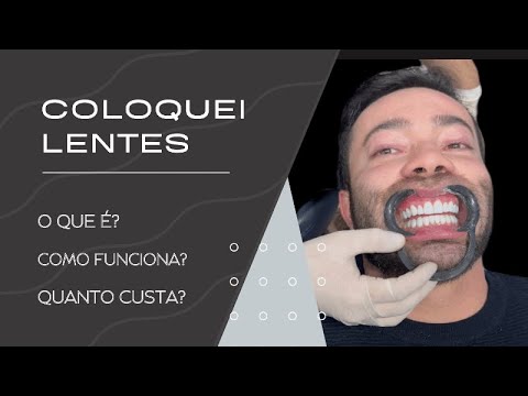 Maromba pode usar Lentes de Contato Dental?