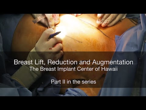 Surgery with Dr. Schlesinger: Breast Lift and Reduction with Implants GRAPHIC - Breast Implant Center of Hawaii