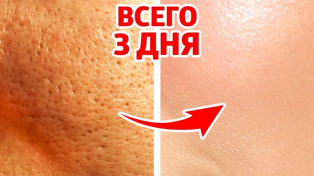Как навсегда уменьшить поры и избавиться от прыщей