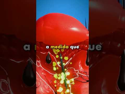 O Que Acontece Quando Você Não Consegue Tirar uma Farpa?
