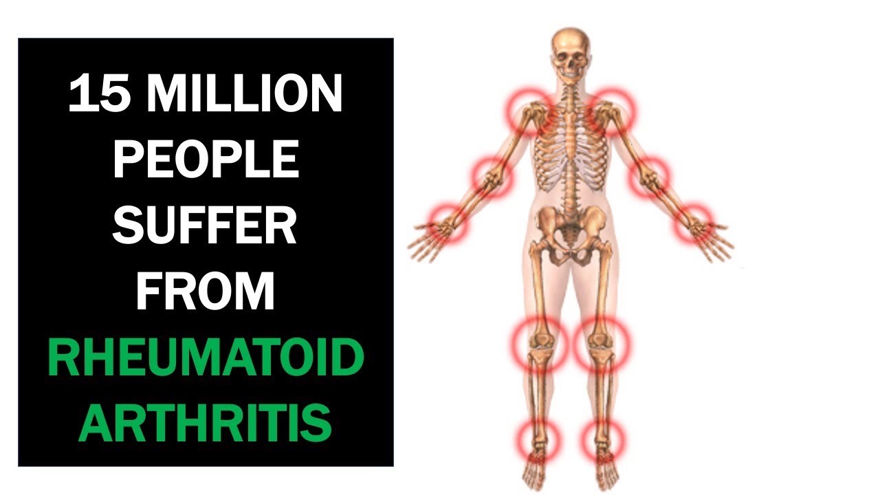 Natural Remedies For Rheumatoid Arthritis That Work￼