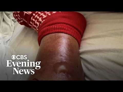 YouTube video thumbnail: Man Survives Flesh-Eating Bacteria as Warmer Ocean Increases Risk off Florida Coast