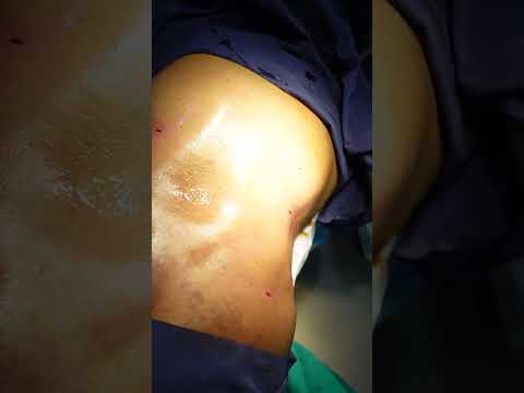 Gynecomastia & Liposuction Surgery #shorts #abdomenliposuction