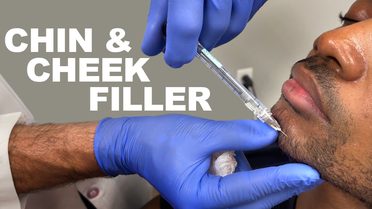 Chin and cheek filler injection process.