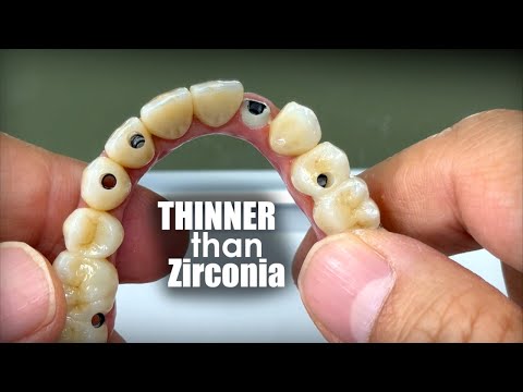 This Restoration Is Thinner & Stronger than Possible With Full-Mouth Zirconia