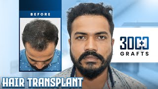 3050 Grafts Hair Transplant in Surat | Amazing Results & Affordable Cost in Surat #hairtransplant