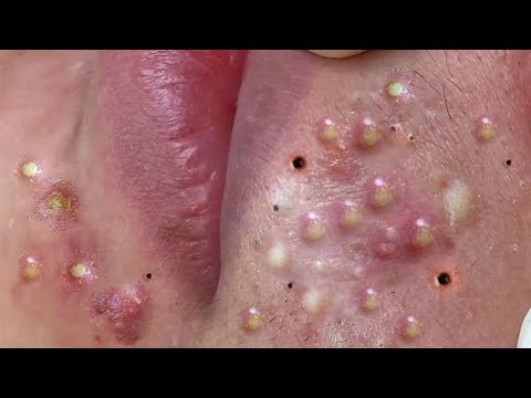 Big Cystic Acne Blackheads Extraction Blackheads & Milia, Whiteheads Removal Pimple Popping # 46637