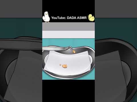 ASMR | Salivary Gland Stones Removal Animation