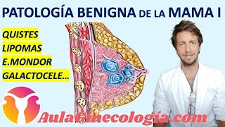 PATOLOGÍA BENIGNA DE MAMA I: QUISTES, MASTOPATÍA FIBROQUÍSTICA y otros. - Ginecología y Obstetricia