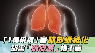怵！醫示警：「1疾病」害肺部纖維化「全都白了」且害「肺腺癌機率」高於常人｜「胸悶+1症狀」是肺塌陷警訊！醫：快就醫！輕忽會奪命｜祝你健康