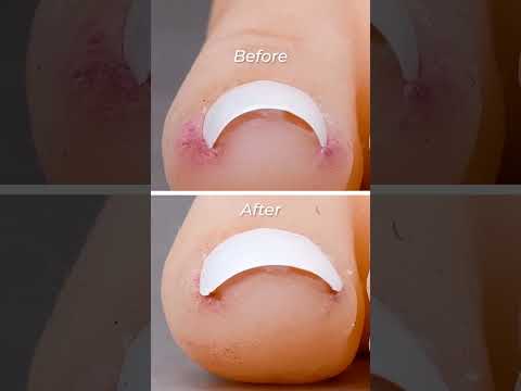 Ingrown toenail gadget hack #shorts