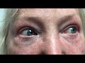Understanding Nystagmus and Central Vertigo