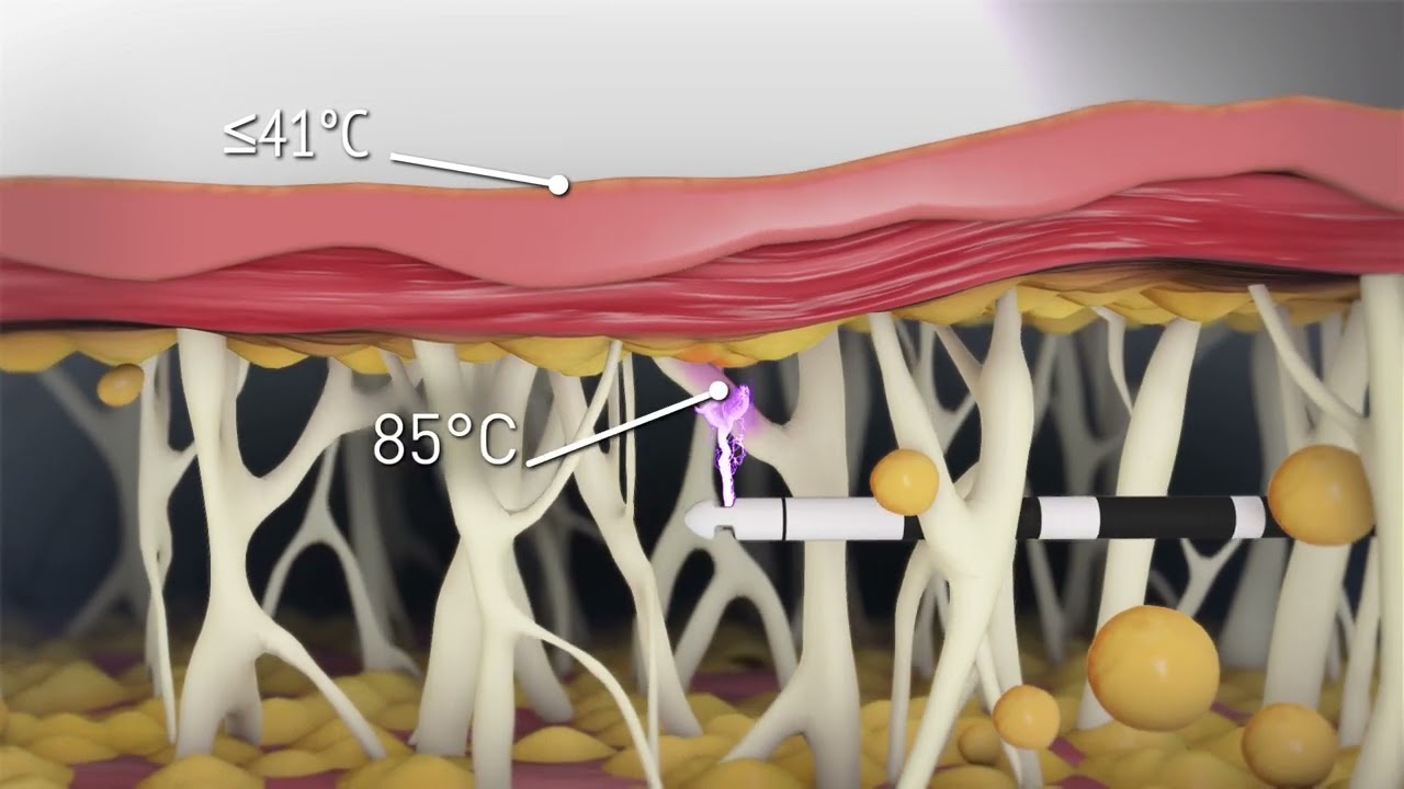 Temperature measurement in skin tissue layers.