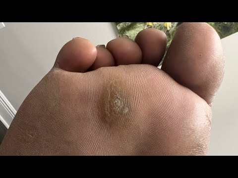 2 CALLUSES IN 1 CALLUS