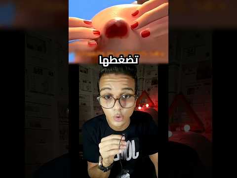 حلزون دخل فى ركبة ولد صغير 😱😳قصة حقيقية