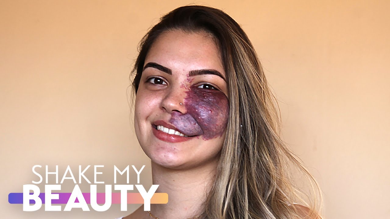 I thought i'd never find love with my birthmark - shake my beauty
