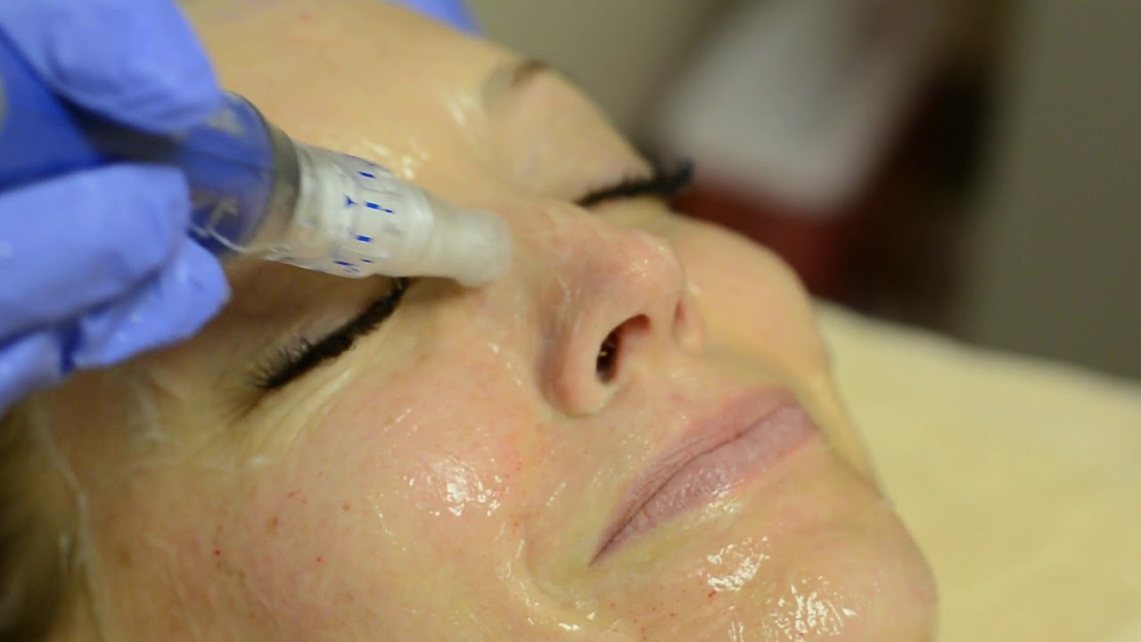 Microneedling treatment on woman's face close-up.