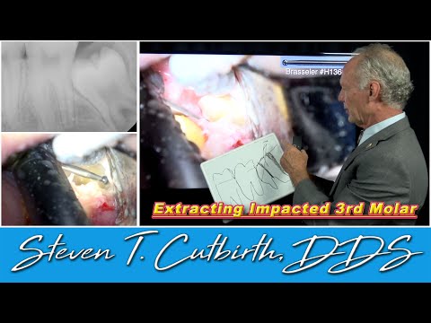 How to Extract an Impacted Third Molar - Dental Minute with Steven T. Cutbirth, DDS