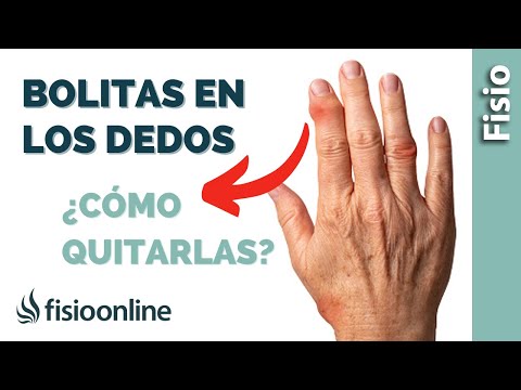 Como CURAR los NÓDULOS en los DEDOS de las MANOS🖐🏻