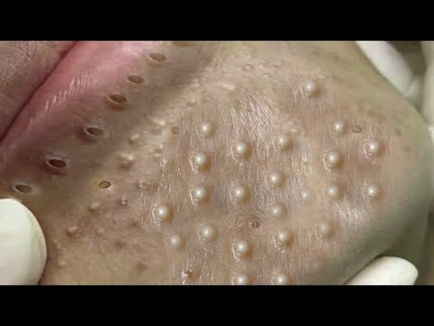 Big Cystic Acne Blackheads Extraction Blackheads & Milia, Whiteheads Removal Pimple Popping # 3916