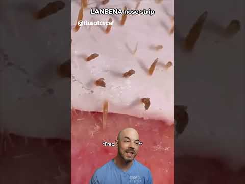 These are some huge blackheads! (credit: @ttusatcvcef on TT) #doctor #satisfying #viral #trending