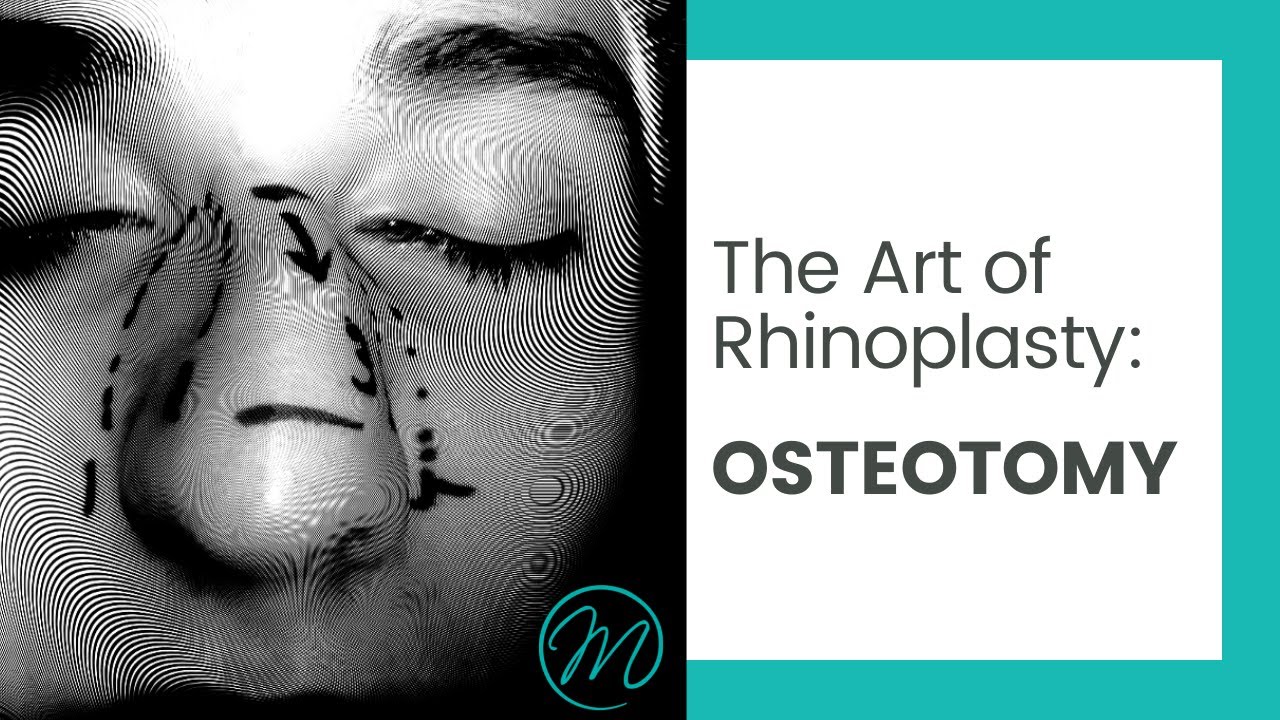 Rhinoplasty illustration focusing on osteotomy techniques.