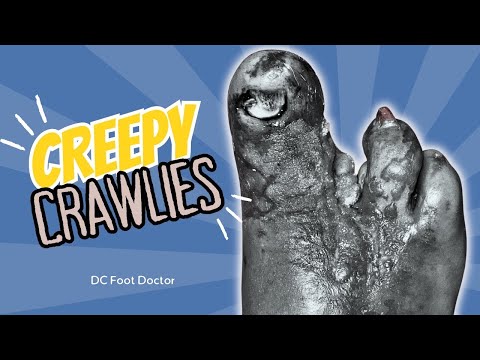 Creepy Crawlies: Saving A Diabetic Foot