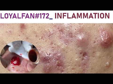 Acne Treatment Huong Da Nang# 172 |  # loyafan Acne inflammation