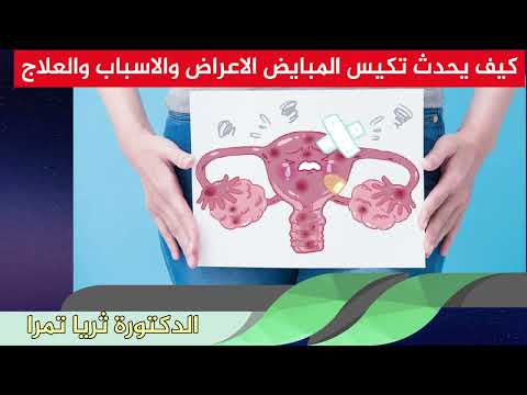 كيف يحدث تكيس المبايض الاعراض والاسباب والعلاج الدكتورة ثريا تمرا