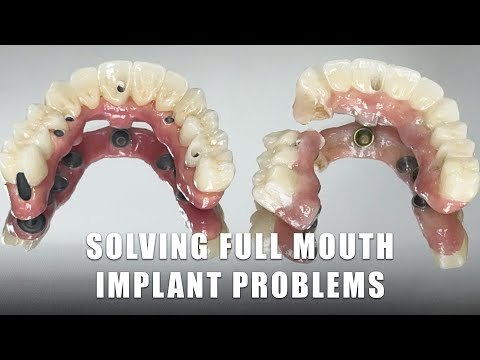 Solving Full Mouth Implant Problems