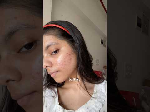 Understanding acne prone skin is not easy 😭 #shortsaday #acne #acneproneskin #acnejourney #acneskin